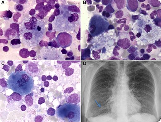 A 73-year-old woman with a medical history of interstitial lung disease, aortic valve surgery, and coronary artery bypass surgery was referred for possible myeloma or lymphoma. Evaluation showed moderate thrombocytopenia (150 × 109/L), monoclonal gammopathy (immunoglobulin G kappa, 2.18 g/L), and hepatosplenomegaly on scans. Bone marrow aspirate (May-Grünwald-Giemsa stain) was infiltrated by numerous foam cells (panels A-B; magnification ×1000) and sea blue histiocytes (panels B-C; magnification ×1000). The foam cells showed cytoplasm filled with numerous small vacuoles. These findings are typical of type B Niemann-Pick disease (NPD). The diagnosis was confirmed by the markedly decreased acid sphingomyelinase activity, whereas the acid β-glucosidase activity was normal, excluding type 1 Gaucher disease. Gene sequencing revealed homozygosity for the mutation encoding p.RΔ610 in the acid sphingomyelinase. Moreover, the chest radiograph showed a typical granular density (panel D). / This is an unusual case of an elderly woman with type B NPD with striking bone marrow findings, suggesting the diagnosis. Although pseudo-Gaucher cells and sea blue histiocytes can be found in bone marrow that is rapidly turning over, the combination of both numerous foam cells and sea blue histiocytes suggests the diagnosis of type B NPD, which should be confirmed by demonstrating the enzyme deficiency and/or gene mutations.