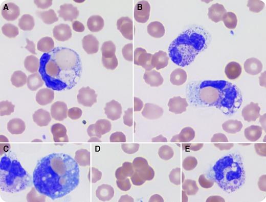 A 3-year-old boy presented with abdominal pain, fever, diarrhea, and dark urine for a few days. Complete blood count showed leukocytosis (white blood cells, 18.62 × 109/L), anemia (hemoglobin, 8.9 g/dL), and thrombocytopenia (platelets, 134 × 109/L). Lactate dehydrogenase, blood urea nitrogen, indirect bilirubin, and creatinine were increased. Hemolytic uremic syndrome (HUS) was clinically suspected based on anemia, thrombocytopenia, elevated creatinine, and diarrhea. Pathology review of the peripheral blood (PB) showed anisocytic erythrocytes with polychromasia, spherocytes, and schistocytes, increased neutrophils with left shift, toxic granulation, vacuolation, and frequent erythrophagocytosis (panels A-B; for all panels, original magnification ×1000, Wright stain). Occasional erythrophagocytosis by monocytes (panel C), red blood cell agglutination (panel D), and platelet phagocytosis by neutrophils (panel E) were also present. Based on these findings, HUS was ruled out and paroxysmal cold hemoglobinuria (PCH) was suspected. A direct antiglobulin test was immunoglobulin G negative but complement positive. The Donath-Landsteiner test was positive and confirmed the diagnosis of PCH. The patient was kept warm and treated supportively; his hemoglobin and platelet count normalized after a month. / PCH is a self-limiting hemolytic disease, but may cause severe anemia and acute kidney injury. Careful evaluation of PB smear is important for immediate recognition and proper management. Erythrophagocytosis by neutrophils is an uncommon phenomenon; its presence with suspected hemolysis should raise the concern for PCH.