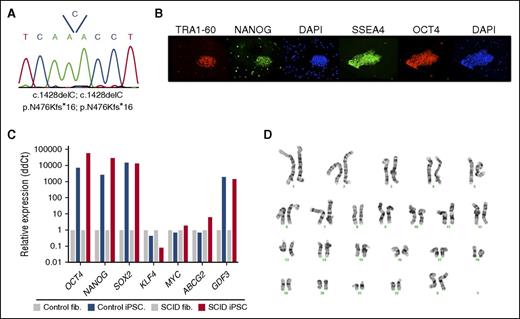 Figure 3. Characterization of an iPSC line reprogrammed from fibroblasts from P1. (A) Sequencing of genomic DNA from the iPSC line, revealing homozygosity for the same single nucleotide deletion at position 1428 identified in parental fibroblasts, and resulting in the p.N476Kfs*16 mutation. (B) Immunofluorescent staining and (C) quantitative PCR analysis of pluripotency markers expressed by the iPSCs. (D) Karyotypic integrity of P1 iPSC line.