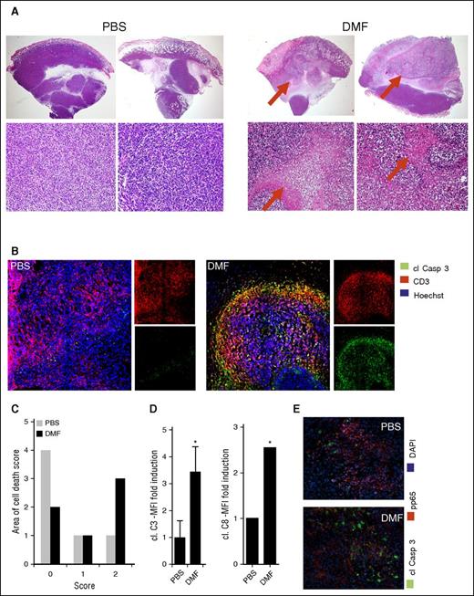 Figure 4. DMF treatment induces massive cell death specifically within CTCL tumors in vivo. HH xenografted tumors grown intradermally in NSG mice that were treated once daily IP with either 30 mg/kg bodyweight DMF or PBS. (A) Representative hematoxylin and eosin–stained specimens of primary HH tumors (upper panels, 20×; lower panels, 200×). (B) Representative pictures of immunofluorescent stainings of primary HH tumors stained for cleaved caspase 3, CD3, and with Hoechst dye, the latter to counterstain nuclei. (C) Semiquantitative score of necrosis areas in the primary xenograft tumors (0% to 25% tumor area covered by necrosis = 0; 25% to 50% tumor area covered by necrosis = 1; 50% to 75% tumor area covered by necrosis = 2; 75% to 100% tumor area covered by necrosis = 3). (D) Quantification of cleaved caspase 3 (left) and cleaved caspase 8 (right) mean fluorescence intensity in HH tumors of either the PBS or DMF treatment group (n = 3 each). (E) Representative immunofluorescent pictures of primary HH xenograft tumors of a PBS- and a DMF-treated mouse stained for cl Casp3, p65, and with Hoechst dye. *P < .05.