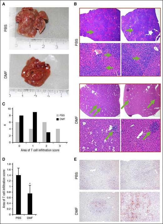 Figure 5. DMF treatment inhibits metastasis of CTCL tumors in vivo. Livers were collected from orthotopically HH xenografted tumor bearers that were treated once daily IP with either 30 mg/kg bodyweight DMF or PBS as control (n = 37, each). (A) Representative macroscopic pictures of an explanted liver of the respective mouse from either a PBS-treated (upper) or a DMF-treated (lower) animal in the intradermal model. (B) Representative pictures of hematoxylin and eosin–stained liver specimens (upper panels, 20×; lower panels, 200×). (C) Semiquantitative score of HH T-cell infiltrate areas within the mouse livers (0% to 25% liver area covered by T cells = 0; 25% to 50% liver area covered by T cells = 1; 50% to 75% liver area covered by T cells = 2; 75% to 100% liver area covered by T cells = 3). (D) Median of the semiquantitative score of HH-T cell infiltrates in liver of DMF- and PBS-treated HH xenograft tumor bearers. (E) Representative picture of liver specimens derived from DMF- and PBS-treated HH xenograft tumor bearers immunohistochemically stained for cleaved caspase 3. Note the positive staining in T-cell foci of DMF-treated tumor bearers, but not in surrounding host tissue. *P < .05.