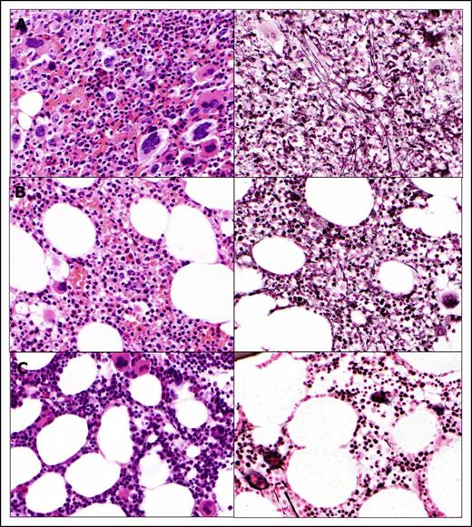 Figure 2. Histomorphologic assessment of bone marrow core biopsy samples. (A) Bone marrow before therapy. Bone marrow after 24 months (B) and after 88 months (C) on therapy. Hematoxylin and eosin staining, original magnification ×500.