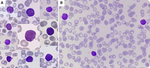 This peripheral blood smear from a 12-year-old child, cytomegalovirus and Epstein-Barr virus negative, 2 months after allogeneic stem cell transplantation (AlloSCT) for acute myeloid leukemia with maturation, shows atypical lymphocytes (panel A; for both panels, original magnification ×100, May-Grünwald Giemsa stain). Laboratory studies showed 42% homogenous atypical lymphocytes in a post-AlloSCT leukopenia (1.6 × 109/L). These cells show an irregular nuclear outline, a round nucleolus, moderately condensed chromatin, and a high nuclear-to-cytoplasmic ratio mimicking lymphoblastic cells (panel B). The forward scatter/side scatter/CD45 panel of the flow cytometric analysis shows 42% of cells located in the lymphocyte gate and no CD45low cells corresponding to blasts. Lymphocyte immunophenotyping revealed an exclusive B-lineage profile of CD19+, CD5+, CD24++, CD27−, CD38++ with polyclonal expression of surface immunoglobulin, typical of transitional B cells. / Transitional B cells are the first B-lymphoid cells detected 1.5 to 2 months after AlloSCT. The proportion of these cells, usually morphologically similar to mature B cells, gradually decreases while the mature B cells increase. This case of blast-like appearance in a young patient with AlloSCT highlights the fact that some transitional B cells can be morphologically confusing with blasts, especially when the initial diagnostic is an acute lymphoid leukemia. Flow cytometry is the best option to differentiate between those 2 immature cells.