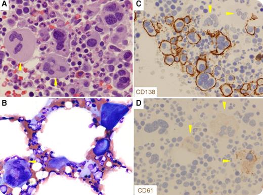 The bone marrow (BM) biopsy (panel A; original magnification ×400 for all panels) from a 59-year-old man showed many giant cells we initially thought of as megakaryocytes (yellow arrowheads). Morphological features different from normal megakaryocytes included relatively high nuclear-to-cytoplasmic ratio, hyperchromic nuclei, perinuclear eosinophilic halo, and nuclear inclusion or prominent nucleoli in some cells. On aspirate (panel B), they had bluish cytoplasm whereas megakaryocytes had purple granular cytoplasm. Immunohistochemistry confirmed them as plasma cells (CD138+ and CD61−) (panels C-D). / The patient was diagnosed as having immunoglobulin A (IgA) κ plasma cell myeloma 2 years ago. The plasma cells had aberrant expression of CD28, CD117 partial, CD20, and loss of CD45, CD19, and CD27. Cytogenetic studies reported a near-tetraploid complex karyotype. Fluorescence in situ hybridization detected gain of CDKN2C (1p32.3)/CKS1B (1q21), FGF3 (4p16), CCDN1 (11q13), and IgH (14q32) locus with variant rearrangement, but was negative for monosomy 13, TP53 deletion, and rearrangement of IgH/CCDN1 and IgH/FGF3. He responded partially to multiple lines of chemoradiation therapy and achieved complete remission after autologous stem cell transplant 5 months ago. However, recent BM biopsy showed relapsed disease with these giant bizarre cells accounting for ∼20% of total plasma cells and 5 to 10 times more than megakaryocytes. This case demonstrates the wide morphological spectrum of plasma cell myeloma.