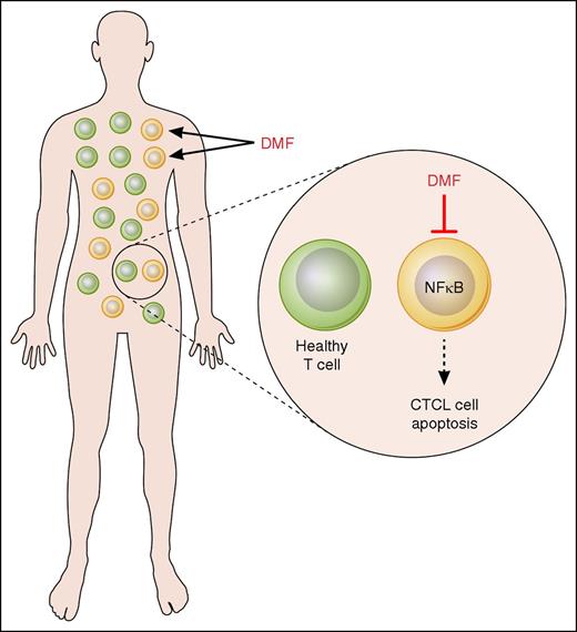 Mechanism of DMF action in CTCL. DMF specifically inhibits NF-κB activity in CTCL cells, thus inducing their apoptosis, while having minimal effect on healthy T cells. Professional illustration by Patrick Lane, ScEYEnce Studios.