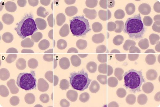 A 63-year-old woman being followed for splenomegaly presented with lymphocytosis (hemoglobin, 14 g/dL; neutrophils, 2.5 × 109/L; lymphocytes, 8.5 × 109/L; monocytes, 0.7 × 109/L; platelets, 200 × 109/L). A blood smear showed 40% medium-sized lymphocytes with abundant cytoplasm with circumferential projections, similar to those of classic hairy cells. The nucleus had condensed chromatin with a conspicuous nucleolus (panels A-F). Flow cytometry revealed 45% clonal B lymphocytes that expressed CD19/CD20/CD22/CD103/CD11c and a lack of CD5/CD10/CD123/CD25/CD200. The BRAFV600E mutation was negative, confirming the diagnosis of hairy cell leukemia-variant (HCL-v). / Despite morphologic similarities, HCL-v is not biologically related to classic HCL (cHCL). HCL-v should be suspected in cases with splenomegaly associated with cytopenias, a normal monocyte count, and lymphocytosis characterized by hairy cells with prominent nucleoli. The immunophenotype CD103pos/CD11cbright/CD123neg/CD25neg supports the diagnosis. CD200 is also useful as it is highly expressed in cHCL and negative in HCL-v. The distinction from splenic diffuse red pulp lymphoma is important and relies on the presence of lymphocytosis with prominent nucleoli observed in HCL-v. The BRAFV600E mutation is found in almost all cases of cHCL but not in HCL-v. TP53 abnormalities and MAP2K1 mutations are found in nearly half of the cases of HCL-v.