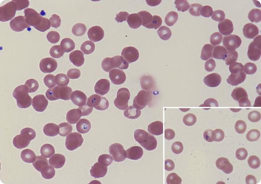 A 34-year-old man with myelofibrosis underwent HLA-matched unrelated donor hematopoietic stem cell transplantation (HSCT) with major ABO incompatibility, complicated by pure red cell aplasia requiring red blood cell transfusion for several months, and by graft-versus-host disease treated with corticosteroids, tacrolimus, and rituximab with subsequent hypogammaglobulinemia. At 14 months post-HSCT, his anemia was starting to improve with decreasing isohemagglutinin level when he presented with fever, headache, malaise, and profound anemia. Lactate dehydrogenase and bilirubin were elevated, haptoglobin was low, and direct antiglobulin test was negative, consistent with nonimmune hemolytic anemia. Peripheral blood showed intraerythrocyte ring forms with central pallor and a merozoite arranged in tetrad configuration resembling a Maltese cross (inset; Wright stain, original magnification ×100 for main panel and inset). Polymerase chain reaction confirmed Babesia microti. The patient denied history of tick bite but lived in an area where Ixodes scapularis is endemic. He was treated with doxycycline, clindamycin, and atovaquone for 6 weeks. His anemia and hemolysis quickly improved and the parasitemia resolved within 2 weeks. / Babesiosis, a tick-borne malaria-like illness, is transmitted via bites by infected Ixodes scapularis and through blood donation from affected asymptomatic individuals. Immunosuppressed patients are more susceptible to infection. Our case illustrates the importance of blood smear review even when other causes of anemia are obvious and underscores that babesiosis can be a cause of post-HSCT anemia.