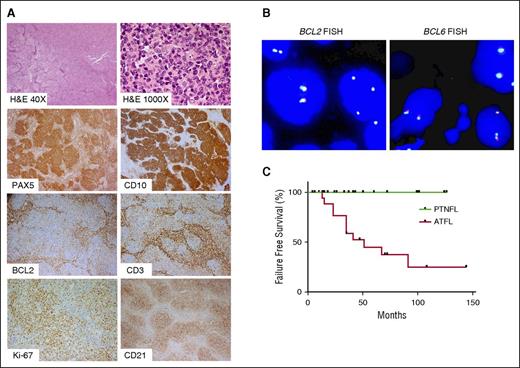 Figure 1. Morphology and immunophenotype of PTNFL. (A) A representative PTNFL showing architectural effacement by follicular proliferation (H&E, ×40). Follicles were composed of medium-sized cells with blastoid features (H&E, ×1000) that were PAX5+ CD10+ with dim or no BCL2 expression. There were scattered occasional CD3+ BCL2+ T cells within follicles. Follicles harbored a tight network of CD21+ follicular dendritic cell meshworks and had a relatively high proliferation index, on the basis of Ki-67 staining. Magnification: ×100 for PAX5, CD10, BCL2, CD3, CD2; ×200 for Ki-67. (B) FISH for BCL2 rearrangement, using LSI BCL2 Dual color break apart rearrangement probe (left), and FISH for BCL6 rearrangement, using LSI BCL6 Dual color break apart rearrangement probe (right). PTNFLs lacked both BCL2 and BCL6 rearrangements as evidenced by colocalization of probes. (C) LSTFL had significantly lower progression-free survival than PTNFL (P < .001).