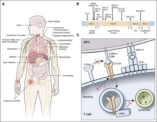Figure 1. CHAI and LATAIE disease phenotype and mechanism. (A) Clinical features of CHAI and LATAIE disease. (B) Schematic of the CTLA4 exons showing the mutations in CHAI patients. TM, transmembrane domain. A schematic displaying LRBA mutations causing LATAIE can be found in Lo et al,12 Alkhairy et al,17 and Gámez-Díaz et al.18 (C) Model depicting the function of CTLA-4 and its regulation by LRBA.
