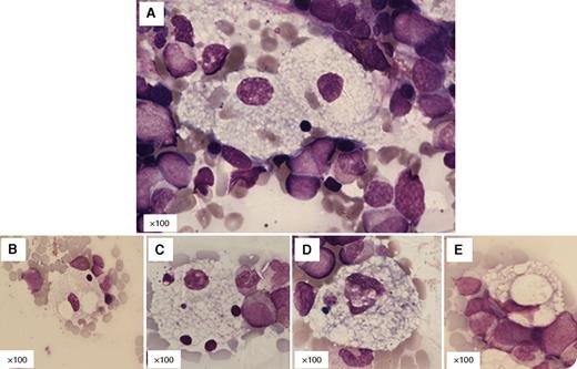 A white girl, born of nonconsanguineous parents at term by spontaneous vaginal delivery, developed neonatal hepatitis with jaundice at 2 months. Jaundice resolved, but by 3 years of age she had developed hepatosplenomegaly. There were no neurological or dysmorphic features. Peripheral blood parameters were normal and there were no vacuolated peripheral blood lymphocytes. In the bone marrow aspirate, scattered large foamy macrophages were visible either around the edges of particles (panel A) or free in the trails (panels B-E). They contained variable-sized vacuoles, some with nuclear debris and inclusions. The features were most consistent with Niemann-Pick type C (NP-C), a neurovisceral metabolic disorder. Abnormal storage cells are only present in about 50% of cases and require observer expertise to identify. There were no “sea-blue” histiocytes as sometimes seen in this disease. / Though NP-C is clinically, biochemically, and genetically distinct from NP-A, differentiating between them by morphology is difficult. Storage cells in NP-C usually demonstrate greater variability in vacuole size, are more likely to contain nuclear debris or inclusions, and are absent of peripheral blood lymphocyte vacuolation. Definitive diagnosis of NP-C requires oxysterol measurement, filipin staining, or confirmation of NPC1, or more rarely NPC2, gene mutations.