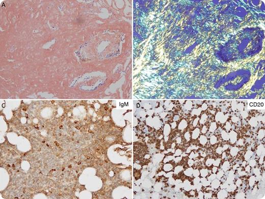 A 67-year-old woman presented with generalized lymphadenopathy (maximum standardized uptake value 3.2). Serum protein electrophoresis/immunofixation showed 2 small immunoglobulin M (IgM)–λ paraproteins (0.47 and 0.62 g/dL). Quantitative serum immunoglobulins and free light chains were unremarkable. Mediastinal lymph node biopsy showed an amyloid tumor and sparse B-cell infiltrate positive for CD19, CD20, and CD22 (negative for CD5 and CD10) with λ restriction. Congo red staining (panel A) showed strong apple-green birefringence (panel B). Liquid chromatography/mass spectrometry showed λ light-chain and μ heavy-chain amyloid. Bone marrow was variably (10% to 70%) involved by a lymphoplasmacytic infiltrate with IgM-λ restriction (panel C). Neoplastic cells expressed PAX5, CD20 (mature B-cell component; panel D), and CD138 (1% plasmacytic component), and were negative for CD5 and CD10. Polymerase chain reaction testing identified an MYD88 L265P mutation. No cardiac, pulmonary, lingual, or renal involvements were identified. A diagnosis of lymphoplasmacytic lymphoma/Waldenström macroglobulinemia (LPL/WM) presenting with secondary IgM amyloidoma was established. / About 2% of patients with amyloidosis present with lymphadenopathy. LPL/WM-associated IgM amyloidoma is an even rarer entity, occurring when IgM-producing lymphoplasmacytic cells secrete amyloidogenic proteins. Lymph node amyloidosis can also occur in chronic lymphocytic leukemia and marginal zone lymphoma, and may be associated with IgM paraproteinemia. Localized lymph node amyloidosis can have heavy-chain or both heavy- and light-chain components.
