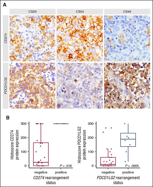 Figure 3. Representative IHC staining and protein level associations based on capture sequencing rearrangement status for CD274 (PDL1) and PDCD1LG2 (PDL2). (A) In case CS29, only macrophages stained for CD274, whereas the majority of tumor cells express PDCD1LG2 due to a focal amplification of the PDCD1LG2 gene locus. CS54 harbored an inversion displacing the 3′ end of CD274 and disrupting the coding sequence of PDCD1LG2. Concordantly, the tumor cells display strong positivity for CD274 and remain negative for PDCD1LG2. CS49 harbors a CBR2 translocation and shows a similar staining pattern as described for CS29. Scale bar, 25 μm. (B) Cases were considered rearranged if they had a CBR translocation or a focal amplification of the gene region. The bold line represents the median, and the box denotes the interquartile range. Individual cases are represented by points. P value was calculated using an exact Wilcoxon-Mann-Whitney test.