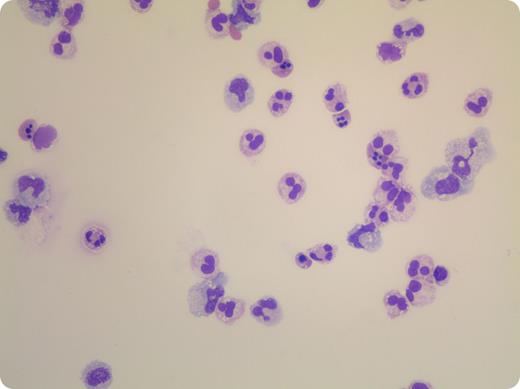 A 60-year-old man with known hepatitis C, cirrhosis, and mild hepatosplenomegaly was admitted for ascites. He had pancytopenia with leukocyte count 2.6 × 109/L, mild neutropenia 1.6 × 109/L, macrocytic anemia, and mild thrombocytopenia. Elevated international normalized ratio, low albumin, high bilirubin, and elevated liver enzymes were noted. Therapeutic paracentesis was performed, and ascitic fluid was reviewed. In the image provided from the ascitic fluid smear, abundant apoptotic neutrophils with 2 or 3 pyknotic nuclei were noted (original magnification ×40; Wright-Giemsa stain). This appearance is not to be confused with yeast forms. / Cirrhotic patients commonly develop neutropenia secondary to hypersplenism and increased sequestration. A lesser known cause of neutropenia may be increased neutrophil apoptosis, which may be due to increased production of reactive oxygen species and enhanced caspase activity. Under normal physiological conditions, there is a balance of regenerating and apoptotic neutrophils. Kupffer cells in the liver promptly clear the apoptotic neutrophils. However, in cirrhotic liver, this process is inefficient and leads to accumulation of apoptotic neutrophils in the ascitic fluid. In conclusion, apoptotic neutrophils can be seen in the ascitic fluid of patients presenting with neutropenia and liver cirrhosis.