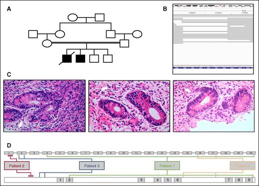 Figure 1. Patients' characteristics. (A) Pedigree for patient 2 with TTC7A deficiency. (B) Integrative Genomics Viewer of whole exome sequencing data from patient 2. Broad gray bars represent sequenced reads aligned to the reference genome. Thin gray bars represent missing/deleted segments (large 34-bp deletion demonstrated in exon 1, confirmed on Sanger sequencing). (C) Hematoxylin and eosin–stained gut biopsies taken pre-HSCT and 6 months and 18 months post-HSCT (from left to right) from patient 2. Unfilled white arrows indicate apoptotic debris. Filled white arrows indicate infiltration of the lamina propria with lymphocytes, eosinophils, plasma cells, and neutrophils. (D) Position of all causative mutations within TTC7A gene (top line: exon 1-20) and position within TTC7A protein (lower line: tetratricopeptide repeat domains 1-9) for all 4 patients.