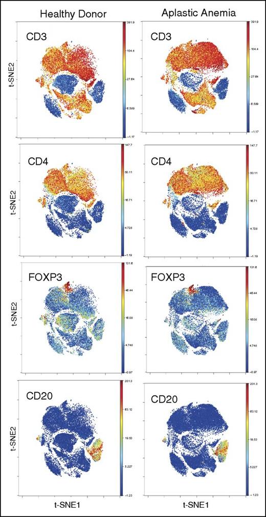 Figure 1. PBMC staining and clustering. PBMCs from AA and HDs were clustered using 34 surface and intracellular markers as our panel 1 (supplemental Table 1). Intact cells were gated based on Ir-191 and event length, followed by Ir-191 and Ir-193 gating. Viable cells were selected based on CD45 expression and negativity for Rh. All FCS files were first normalized using control beads and analyzed using Cytobank web-based software (see “Methods”). CD4+ and CD8+ T and B cells clustered together in both AA and HDs. Figures are representative of 16 AA and 5 HD samples.