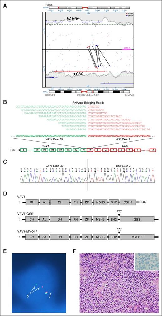 Figure 2. Identification and validation of VAV1 fusions in PTCL, NOS. (A) Rearrangement of VAV1 and GSS genes as detected in genomic DNA by MPseq. Vertical and oblique black lines represent aberrant read-pairs; blue ends indicate mapping to (+) strand, whereas red ends indicate mapping to (−) strand. (B) VAV1-GSS fusion transcript as detected by RNAseq. Bridging reads spanning the fusion site are shown. TSS, transcription start site. (C) Sanger sequencing of the fusion site in VAV1-GSS fusion. (D) Schematic diagrams of VAV1 protein domains in wild-type VAV1 and resulting from VAV1 fusions. (E) FISH confirming a VAV1 rearrangement in a tumor cell nucleus (blue) from a PTCL, NOS specimen. The normal intact VAV1 allele is indicated by a red-green fusion (f) signal. Disruption of the VAV1 gene region on the other allele is indicated by separation (s) into one red (5′) signal and 1 green (3′) signal. (F) Pathologic features of PTCL, NOS with VAV1 fusion (hematoxylin and eosin stain; inset, CD30 immunostain). Original magnification ×400 (inset, ×1000).