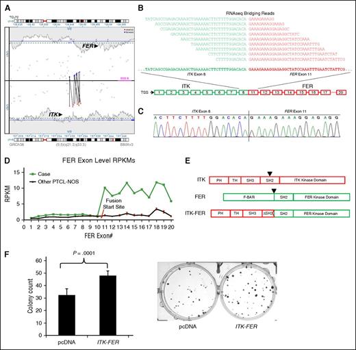 Figure 5. Novel ITK-FER kinase fusion in PTCL, NOS. (A) ITK-FER rearrangement as detected by MPseq. (B) ITK-FER fusion transcript as detected by RNAseq. (C) Sanger sequencing of the ITK-FER fusion site. (D) Exon-level RNAseq read plot for FER in TCL72 (“Case”) compared with the remaining 10 sequenced cases of PTCL, NOS. RPKM, reads per kilobase per million. (E) Schematic diagrams of protein domains in ITK, FER, and the ITK-FER fusion protein. (F) ITK-FER expression promotes colony formation in HEK-293 cells. PH, pleckstrin homology; TH, Tec homology; SH, Src homology; F-BAR, FER-CIP4 homology–Bin-amphiphysin-Rvs.