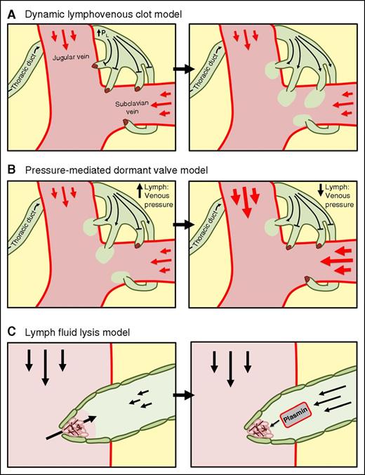 Figure 1. Model of lymphovenous clot dynamics and lymph flow. (A) Lymphovenous clots block retrograde blood flow and increasing lymphatic pressures until the clots are resolved and a bolus of lymph fluid is infused into the bloodstream. (B) Lymphovenous clot formation at several lymphovenous junctions preventing retrograde or forward flow, but allowing flow in the remaining active vessels. (C) Lymphovenous clot formation occurs when the lymphovenous junction is in a blood environment, and the clot is resolved as lymph fluid envelops the clot, mediating fibrinolysis and forward lymph flow. PL, lymphatic pressure.