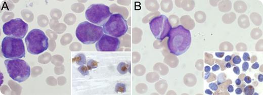 A 34-year-old patient A (panel A) and a 65-year-old patient B (panel B) presented with hyperleukocytotic acute myeloid leukemia (AML; white blood cells 127 × 109/L and 83 × 109/L, respectively, with 98% and 99% blasts). Leukemic cells in the peripheral blood of both patients showed very similar cytomorphologies, with bilobed nuclei and cup-like nuclear invaginations in 34% (patient A) and 44% (patient B) of blasts. Single Auer rods were occasionally observed. Myeloperoxidase staining was strongly positive in both cases and mainly localized to the “cup” (insets). Molecular testing revealed a promyelocytic leukemia–retinoic acid receptor α (PML-RARα) fusion and an Fms-like tyrosine kinase 3 (FLT3) internal tandem duplication in patient A, whereas a nucleophosmin-1 (NPM1) mutation was detected in patient B. Fluorescence in situ hybridization confirmed t(15;17) in patient A and excluded RARα rearrangements in the other patient. In summary, patient A was diagnosed with microgranular acute PML, whereas patient B was diagnosed with NPM1-mutated normal karyotype AML. / Cup-shaped blasts are predominantly discussed in the recent literature for their association with NPM1 and FLT3 mutations in normal karyotype AML. However, microgranular acute promyelocytic leukemia, with its nuclear bilobation, may exhibit very similar cytomorphology, mimicking cup-like nuclear invaginations. In light of the immediate diagnostic and therapeutic consequences, the hematologist should consider both differential diagnoses when evaluating AML blood smears with prominent cup-like nuclear morphology.