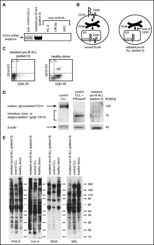 Figure 1. CD81 loss in blasts from ALL patient 3 disrupts CD19 membrane trafficking. (A) Reverse transcription polymerase chain reaction (RT-PCR) analysis of CD19 mRNA expression in ALL patient 3 and primary CLL+ control cells as well as PC-3 and LNCap prostate negative control cell lines. (B) Schematic representation of CD81-dependent CD19 cell surface transport via endoplasmic reticulum (ER) and Golgi compartments. (C) Flow cytometric analysis of CD81 membrane expression on blasts from ALL patient 3 and healthy donor CD19+ B cells. (D) CD19 western blot analysis using lysates from ALL patient 3 and control CLL cell lysates ± PNGaseF treatment of deglycosylation. (E) Lectin western blot analysis revealing global glycosylation patterns in cell lysates from ALL patient 3 and control CLL as well as healthy donor blood cell lysates. B-ALL, B-cell ALL; PE, phycoerythrin.