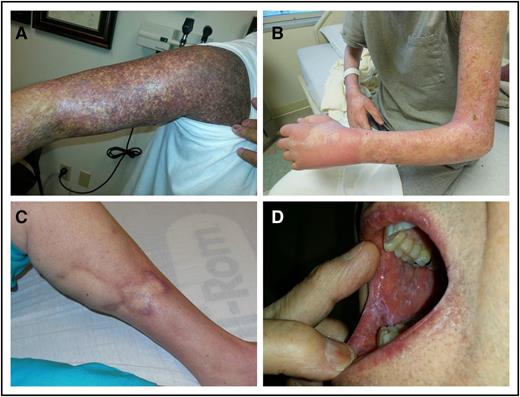Figure 2. Diagnostic skin and mouth manifestations. (A) Lichen planus and poikiloderma. (B) Fasciitis and sclerosis. (C) Sclerosis. (D) Oral lichen planus.
