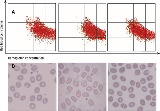 A 52-year-old Malaysian man, a 24-year-old sub-Saharan woman, and a 28-year-old Madagascan woman (who was heterozygous for hemoglobin S) were admitted to North Hospital in Marseilles, France. Blood tests using an Advia2120i hematology analyzer (Siemens) showed no or mild anemia (109-150 g/L), normal or high mean corpuscular hemoglobin concentration (339-364 g/L), and borderline or slightly high red cell distribution width (15%-19.2%). / The red blood cell (RBC) volume and hemoglobin concentration cytogram clearly showed a typical distribution of comma-shaped RBCs, with an increased number of hyperchromic RBCs (panel A). Examination of the blood smear revealed anisocytosis and poikilocytosis, without spherocytes but with ovalocytes and macro-ovalocytes, some of them with more than 1 ridge (panel B; original magnification ×100, May-Grünwald Giemsa stain). The eosin-5′-maleimide binding test performed for each patient showed a reduced mean channel fluorescence between 26.2% and 30.9%, confirming an anomaly of the band-3 protein. A heterozygous 9-amino-acid deletion (residues 400 to 408) in band 3 (SLC4A1), which is the most common genetic abnormality in Southeast Asian ovalocytosis (SAO), was found in all 3 patients. Most cases of SAO are asymptomatic, so careful examination of a cytogram from the Advia2120i analyzer and close observation of the blood smear can help diagnose SAO.