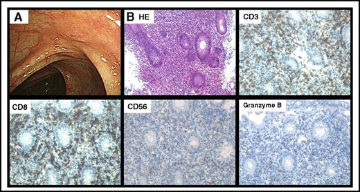Figure 1. Features of dasatinib-induced hemorrhagic colitis. Representative endoscopic finding of CF1 (A) and immunohistopathological analysis of a representative colon biopsy specimen (B). Original magnification ×200 for panel B. CD, cluster of differentiation; HE, hematoxylin and eosin.
