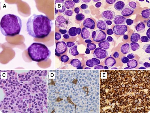 A 63-year-old woman presented with fatigue that increased over 2 months. The blood work showed a white blood cell count of 3.8 × 109/L, hemoglobin of 8.8 g/dL, platelet count of 51 × 109/L, and immunoglobulin G kappa paraproteins. There was no evidence of bone lytic lesions by imaging analysis. A bone marrow aspiration demonstrated diffuse infiltration of mononuclear cells, including the blast-like cells which showed dispersed chromatin, high nuclear-cytoplasmic ratio, and the nucleus concentrically placed with no perinuclear hof (panels A and B; original magnification ×100; May-Grünwald-Giemsa stain). Immunohistochemistry on bone marrow biopsy (panel C; original magnification ×40; hematoxylin and eosin stain) revealed sheets of abnormal cells that were positive for CD138 (panel E; original magnification ×40; CD138 immunostain), MUM1, CD79b, CD117 (dim, partial), and cytoplasmic kappa and were negative for CD34 (panel D; original magnification ×40; CD34 immunostain), TdT, MPO, CD33, CD68, CD56, lysozyme, and CD3. A deletion of chromosome 13q14 was detected by fluorescence in situ hybridization. Overall, the findings were consistent with a plasma cell myeloma with plasmablastic features. / Plasmablastic type is an uncommon aggressive morphologic variant of multiple myeloma with an adverse outcome. This feature is associated with several unfavorable risk parameters, including higher international staging score, more frequent renal insufficiency, extensive bone marrow infiltration, increased plasma cell labeling index, and del(13q). Because myeloma cells can express myelomonocytic markers, and because the blasts of acute myeloid leukemia may express CD56 and CD38, knowing about this morphologic variant is important to distinguish it from acute leukemia.