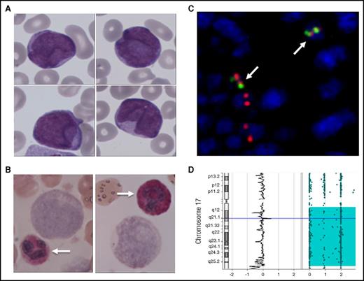 Figure 1. Cytological and molecular characterization of a MPO-negative APL. (A) May Grünwald Giemsa staining of a blood smear showing medium-sized myeloid blasts without granulation or Auer rods. (B) Cytochemical evidence for MPO negativity of blast cells (as compared with neutrophils; arrows). (C) Molecular evidence of the t(15;17) translocation by fluorescent in situ hybridization showing double fusion signals in blast cells (arrows). (D) Single nucleotide polymorphism analysis showing a uniparental disomy of the long arm of chromosome 17. Original magnification ×400 for panels A-B.