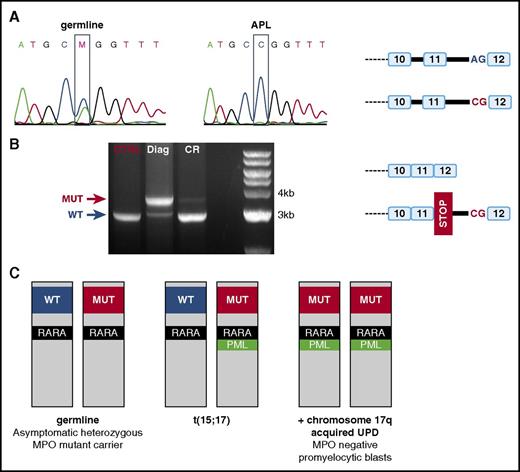 Figure 2. Molecular mechanism of MPO deficiency in blast cells. (A) Sanger sequencing of the intron 11 of MPO, showing a c.2031-2A>C mutation of the intronic 3′ splice acceptor site, which is heterozygous in germline (left) and homozygous in APL (middle). The right panel is a schematic representation of the 2 MPO alleles. (B) Polymerase chain reaction analysis of the MPO mRNA, showing intron 11 retention in the APL diagnosis sample (Diag) and not in the sample collected at the time of molecular complete remission(CR). A control mRNA (CTRL) was used to identify the normal size of MPO mRNA. The right panel is a schematic representation of the wild-type (WT) and mutant MPO mRNA. (C) Schematic overview of the molecular oncogenesis explaining this MPO-negative APL case. The patient is an asymptomatic heterozygote carrier of an MPO-deficient allele (MUT, left), who developed APL after t(15;17)(PML-RARA) translocation (middle). Because t(15;17) is located on chromosome 17 with the MPO-deficient allele, the 17q UPD results in homozygous MPO-deficient blast cells (right).