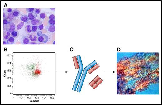 (A) Bone marrow aspirate with few plasma cells (original magnification ×100, Giemsa stain). (B) Flow cytometry plot of bone marrow showing λ-positive plasma cells (in red) and polyclonal B cells (in green). Anti-κ (TB 28-2) allophycocyanin stain (APC), Becton, Dickinson (BD), catalogue number: 341108; Anti-Λ (1-155-2) APC-H7, BD, catalogue number: 656648. (C) Heavy chain in blue; Λ light chains in red. (D) Amyloid deposits in a fat aspirate (original magnification ×10, congo red staining, polarized light). Professional illustration by Patrick Lane, ScEYEnce Studios.