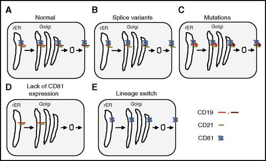 Mechanisms of CD19-targeted immune escape. The B-cell coreceptor complex consists of CD19, CD21, CD81, and CD225 (for simplicity CD225 is omitted here). It is assembled in the rough endoplasmic reticulum (rER) and transported to the Golgi apparatus where the carbohydrate moieties are processed before being transported to the cell surface. Carbohydrate processing is indicated only for CD19 (light red: unprocessed carbohydrates; dark red: processed carbohydrates). (A) Normal processing and transport of CD19. (B) Splice variants resulting in loss of the extracellular domain of CD19. (C) Mutations resulting in a conformational change of the extracellular domain of CD19. (D) Loss of CD81 expression resulting in intracellular accumulation of CD19 with unprocessed carbohydrates. (E) Lineage switch resulting in transcriptional silencing of CD19 expression.