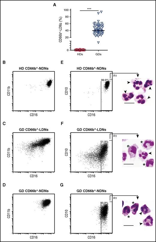 Figure 1. Frequency and phenotypic/morphologic characterization of CD66b+ LDNs and CD66b+ NDNs from GDs. (A) Frequency of CD66b+ LDNs within CD45+ PBMCs from HDs (n = 44) and GDs (n = 53). Graph values indicate medians from independent experiments. Each symbol stands for a single HD or GD. ***P ≤ .001, by the Mann-Whitney U test. (B-D) Representative fluorescence-activated cell sorter (FACS) plots displaying CD16 and CD11b expression in CD66b+ NDNs from HDs (B) or CD66b+ LDNs (C) and CD66b+ NDNs (D) from GDs. (E-G) Representative FACS plots (left column) displaying CD10 and CD16 expression in CD66b+ NDNs from HDs (E) or CD66b+ LDNs (F) and CD66b+ NDNs (G) from GDs. Representative May-Grünwald Giemsa stained cytospins (right column; scale bar = 10 μm) of sorted CD16+ (R1) cells from CD66b+ NDNs from HDs (E) or CD66b+ LDNs (F) and CD66b+ NDNs (G) from GDs. Examples of segmented neutrophils (▼), band cells (*), and metamyelocytes (○) are reported.