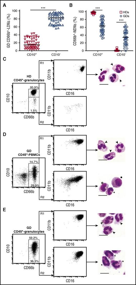 Figure 2. Frequency and phenotypic/morphologic characterization of mature CD10+ and immature CD10− neutrophils within CD66b+ LDNs and CD66b+ NDNs from GDs. (A-B) Frequency of CD10+ and CD10− cells within CD66b+ LDNs in PBMCs from GDs (n = 53) (A) or within CD66b+ NDNs from HDs (n = 44) and GDs (n = 53) (B). Graph values indicate medians from independent experiments. Each symbol stands for a single HD or GD. ***P ≤ .001, by the Mann-Whitney U test. (C-E) Representative FACS plots of CD11b and CD16 expression and May-Grünwald Giemsa stained cytospins (scale bar = 10 μm) of CD66b+CD10+ (R1) or CD66b+CD10− (R2) cells within CD45+ granulocytes from HDs (C) or GDs (E) and CD45+ PBMCs (D) from GDs. Examples of segmented neutrophils (▼), band cells (*), metamyelocytes (○), and myelocytes (●) are reported.