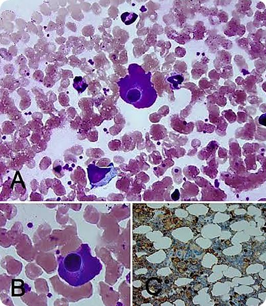 A 56-year-old diabetic woman presented with significant proteinuria. Serum protein electrophoresis demonstrated an elevated α2 region. Immunofixation confirmed immunoglobulin A-λ (IgA-λ) monoclonal protein (unquantifiable). The serum IgA level was 763 mg/dL (normal range, 83-407 mg/dL). The serum κ/λ free light chain ratio was 0.5 (normal range, 0.26-1.76). The result of urine protein electrophoresis was negative for monoclonal proteins. Blood counts, blood chemistry, and skeletal survey findings were normal. The bone marrow aspirate smear showed plasma cells with abundant eosinophilic cytoplasm consistent with flame cells (panels A-B; original magnification ×100; Wright-Giemsa stain). There was a λ light chain (dim) restricted plasma cell population (∼5% on bone marrow core biopsy specimen) (panel C; original maginification ×40; CD138 immmunohistochemistry stain). Overall, findings were consistent with IgA monoclonal gammopathy of undetermined significance. / Historically, flame cells were used to identify IgA monoclonal proteins and are more often reported in association with IgA myeloma. The “flaming” phenomenon can be uncommonly seen in other myeloma types and in reactive inflammatory states. There is no definitive evidence to suggest an association with myeloma progression or aggressiveness. The deeply stained pinkish hue at the cell periphery is thought to be the result of precipitated carbohydrate-rich IgA in the endoplasmic reticulum, which appears in stark contrast to the perinuclear halo of the Golgi apparatus. The patient continues to receive follow-up care and has stable renal function, which is now presumed to be diabetes related.