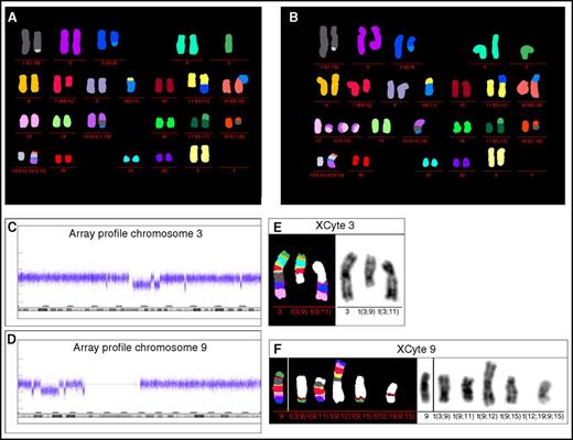 Figure 3. M-FISH, barcode FISH, and array profile patient 2. (A-B) M-FISH identified the additional marker and ring chromosomes. Both metaphases show the same aberrations, but in panel B, the ring chromosomes were identified as composed of material from chromosomes 13 and 15. Array profile revealed chromothripsis of the long arm of chromosome 3 and from the short arm of chromosome 9 (C-D). In this patient, the ring chromosome material 13 and 15 showed no chromothriptic pattern in array analysis; however, due to the low number of metaphases showing ring chromosomes (2 of 14), array-CGH may not be able to detect a chromothriptic event. (E) XCyte bar coding of chromosome 3 showed the banding pattern of the normal chromosome 3 and additionally the p-arm banding pattern on the derivative translocation chromosome t(3;9) and long arm banding pattern on the derivative translocation chromosome t(3;11). The centromeric banding pattern of chromosome 3 is not detectable according to the chromothriptic array profile of chromosome 3. (F) XCyte 9 barcode. A normal control hybridization of XCyte barcode 9 is presented on the left side. In the patient, the XCyte barcode is distributed on 5 translocation chromosomes. Chromosomal material involved in chromothriptic region 9p could be localized on the translocation chromosomes t(3;9), t(9;15), and the complex rearranged translocation chromosome t(12;19;9;15). Note, unstained translocation partners are indicated in white.