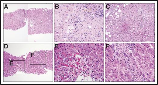 Figure 2. Liver biopsy from patient with acute liver failure after HSCT compared with example cases. (A) Example case, low power image of GVHD (left) with minimal lobular inflammation in contrast to IPI-associated hepatitis (right) showing pronounced lobular hepatitis (original magnification ×50; hematoxylin and eosin stain). (B) Example case, high power view of a portal tract in a patient with GVHD exhibiting cholestasis and bile duct injury, evidenced by cells with nuclear pleomorphism, eosinophilic cytoplasm, and intracytoplasmic vacuoles (original magnification ×400; hematoxylin and eosin stain). (C) Example case, high power image of IPI-associated hepatitis exhibiting a pan-lobular, predominantly lymphocytic infiltrate with spotty hepatocellular necrosis (original magnification ×200; hematoxylin and eosin stain). (D-F) Patient case demonstrating striking centrizonal hemorrhage and hepatocellular dropout as well as bile duct injury. (D) Original magnification ×50; hematoxylin and eosin stain. (E) Original magnification ×400; hematoxylin and eosin stain. (F) Original magnification ×400; hematoxylin and eosin stain.