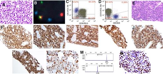 The patient is a 65-year-old man with HIV/AIDS. In February 2016, he presented to an outside hospital with ascites (panel A; hematoxylin and eosin stain, original magnification ×400) and a diagnosis of MYC-rearranged (panel B) CD5–dimly positive (panel C) “aggressive large B-cell lymphoma.” There was no CD3 (panel D) or rearrangement of BCL2 or BCL6. He was treated and his ascites resolved, but a follow-up scan many months later showed a renal lesion. A renal core biopsy showed medium-sized lymphoid blasts (panel E; hematoxylin and eosin stain, original magnification ×400) positive for CD10 (panel F; original magnification ×400), CD19 (panel G; original magnification ×400), terminal deoxynucleotidyl transferase (TdT; panel H; original magnification ×400), and cellular myelocytomatosis viral oncogene (panel I; original magnification ×400), with coexpression of CD5 (panel J; original magnification ×400) and nearly 100% Ki-67 (panel K; original magnification ×200), negative for CD34 (not shown). Interestingly, these blasts were dimly positive for CD3 (panel L; original magnification ×400). Polymerase chain reaction showed monoclonal IGK rearrangement (panel M, lanes 1 and 2) with germ line TRG; thus, a diagnosis of B-lymphoblastic lymphoma (B-LBL) was established. Retrospective immunohistochemistry of the ascites specimen pulled in February 2016 showed the blasts were positive for TdT (panel N; original magnification ×400). / This is an interesting case of B-LBL with several unusual features: in an HIV-positive patient, an initial presentation as ascites but later as a renal mass without bone marrow or blood involvement, and the first case of B-LBL with aberrant expression of CD5 and acquisition of CD3, the latter of which could be caused by lineage infidelity. Because of TdT immunoreactivity, this case shall not be diagnosed as high-grade B-cell lymphoma, not otherwise specified, as specifically defined by the 2016 revision of the World Health Organization’s classification of lymphoid neoplasms.