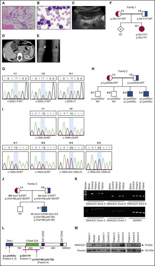 Figure 1. Clinical characteristics of Patient 1. (A) Reduced cellularity is apparent in the marrow biopsy. Hematopoietic activities occupy ∼40% of the space between bones. Surrounding fat tissue is seen. Original magnification ×100. (B) Bone marrow aspirate shows no evidence of dysplasia, cytoplasmic vacuoles, ringed sideroblasts, or excess blasts. Original magnification ×500. (C) Imaging of the pancreas showed hyperechogenicity (arrow) on ultrasonography (imaging of a normal pancreas can be found in supplemental Figure 2D). (D) Computed tomography scan showed hypodense tissue (arrow). The ultrasound and computed tomography images are characteristic features of lipomatosis seen in SDS. (E) Radiograph of the long bones showed irregularity of the metaphyses with areas of sclerosis (black arrow) and lucency (white arrow). Similar images of Patient 3 can be found in supplemental Figure 1. (F) Pedigree of Family 1. (G) Sanger sequencing was done to validate mutations in DNAJC21 (NM_001012339.2) found by whole-exome sequencing. The figure indicates the position of the mutation (c.520) on exon 5. The nucleotide substitution of C by T is seen in homozygous (patient, II-1) and heterozygous (parents, I-1 and I-2) states, consistent with recessive inheritance. The alteration results in premature protein truncation (p.Gln174*). (H) Pedigree of Family 2. (I) Sanger sequencing of portion of exon 2 of DNAJC21 in family members showing segregation of the pathogenic missense variant. (J) Pedigree of Family 3. (K) PCR of genomic DNA from patient 4 showing absence of amplification of exons 5 and 6, and normal amplification of surrounding exons and glyceraldehyde-3-phosphate dehydrogenase control. (L) The DNACJ21 protein with its domains and predicted patients’ mutations are shown. (M) Immunoblots of protein extracts of cells from controls and members of Family 1 (left, peripheral blood T cells), Patient 2 (center, peripheral blood T cells), and Patient 4 (right, marrow fibroblasts) with DNAJC21 and loading control antibodies. Band densitometry was performed with ImageJ software. NT, not tested.