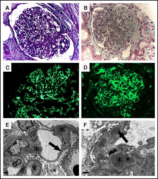 Figure 2. Kidney biopsy findings of monoclonal gammopathy–associated C3 glomerulopathy. (A-B) Light microscopy. (A) Section of renal cortex showing mesangial proliferative glomerulonephritis (periodic acid–Schiff staining, ×400). (B) Diffuse membranoproliferative glomerulonephritis with nodular appearance of the mesangium and glomerular capillary wall deposits (light green trichrome, ×400). (C-D) Immunofluorescence microscopy. Diffuse granular capillary wall and mesangial bright deposits (anti-C3 fluorescein isothiocyanate-conjugate, ×400). (E-F) Electron microscopy. (E) Nodular (pseudohumps) electron-dense mesangial deposits (asterisk) and intramembranous dense deposits (arrow). Scale bar, 1 µm (original magnification ×8000). (F) Nodular electron-dense mesangial deposits (asterisk) and interrupted intramembranous dense deposits displaying a sausage-shaped (arrow). Scale bar, 1 µm (original magnification ×15 000).