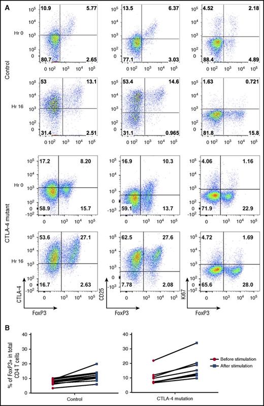 Figure 3. T-cell stimulation increases Treg detection by upregulating Foxp3 expression. (A) CD4 T cells were analyzed for Foxp3, CTLA-4, and CD25, Ki67 in a healthy control and a CTLA-4–deficient patient at 0 hours (Hr) and 16 hours after CD3/28 bead stimulation. (B) Percentage of Tregs before or after bead stimulation in controls and individuals with CTLA-4 mutations.