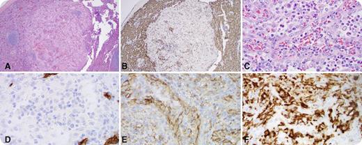 A 21-year-old man presented with immune thrombocytopenic purpura refractory to steroids and intravenous immunoglobulin. Imaging revealed mild splenomegaly without lesions. Laparoscopic splenectomy was performed for refractory thrombocytopenia. Gross examination showed a 250-g spleen without abnormalities. Histologically, a single, well-circumscribed, 2-mm subcapsular lesion with anastomosing vascular channels was identified. The vascular spaces were lined with tall columnar endothelial cells without atypia (panels A and C, hematoxylin and eosin stain; panel A, original magnification ×4; panel C, original magnification ×50). The lesion was negative for CD8 (panel B; original magnification ×4) and CD34 (panel D; original magnification ×50) and positive for CD31 (panel E; original magnification ×50) and CD163 (panel F; original magnification ×50) by immunohistochemistry. / Littoral cell angiomas (LCAs) are rare primary vascular neoplasms of the spleen originating from littoral cells that line red pulp sinuses. Unlike normal littoral cells, LCAs are classically negative for CD8. They are often discovered incidentally or the patient may present with abdominal pain, fever, and symptoms of hypersplenism. In this case, it is unlikely that such a small solitary lesion contributed to the patient’s thrombocytopenia. Definitive diagnosis requires histologic and immunohistochemical studies after splenectomy. LCAs were originally thought to be benign, but recently, they have been described as having some malignant potential as well as an association with visceral malignancies and immunologic disorders. Given these possibilities, close clinical follow-up is recommended.