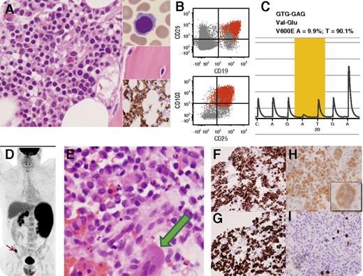 A 44-year-old man presented with splenomegaly, pancytopenia, and occasional circulating hairy cells (panel A upper inset; original magnification ×1000, Wright-Giemsa stain). A B-cell infiltrate was detected in the bone marrow (panel A, original magnification ×400, hematoxylin and eosin stain; lower inset is CD20 immunohistochemistry, original magnification ×400); by flow cytometry, B cells were positive for CD11c, CD19, CD20, CD25, and CD103 (panel B). Pyrosequencing confirmed a BRAF c.1799T>A p.V600E mutation (panel C). A diagnosis of hairy cell leukemia was established. The patient was observed and presented 9 months later with leg pain. 18-Fluorodeoxyglucose positron emission tomography demonstrated splenomegaly, abdominal lymphadenopathy, and a hypermetabolic right iliac bone lesion (panel D, arrow). Biopsy of the bone lesion showed sheets of medium-sized cells with frequent nuclear grooves, dispersed chromatin, and abundant cytoplasm (panel E; original magnification ×400, hematoxylin and eosin stain); occasional multinucleated giant cells (panel E, green arrow) exhibiting similar nuclear features were also identified. These cells were positive for CD1a (panel F; original magnification ×400), langerin (panel G; original magnification ×400), and BRAF V600E protein (panel H; original magnification ×400; inset is a BRAF V600E+ giant cell), and were negative for CD19, CD20 (panel I; original magnification ×400), and PAX5, confirming the diagnosis of Langerhans cell histiocytosis. We performed polymerase chain reaction followed by capillary electrophoresis using DNA and showed monoclonal peaks of identical size in both neoplasms. / This case exhibits the concurrent presence of 2 distinct neoplasms arising from divergent differentiation of a BRAF mutated common progenitor cell.