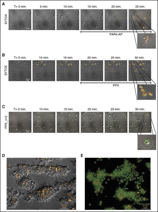 Figure 2. Membrane-associated polyphosphate is incorporated into platelet aggregates. Microscopic images were acquired at a magnification of ×1000 (A-D) and ×630 (E). Scale bar is shown in the left panels (10 μm). All images are shown at the same magnification; insets show indicated areas at higher magnification. Times (above) represent the time course, starting from the moment of first stable platelet adhesion in the image field. (A) Time series of spreading and degranulation of platelets in citrated plasma on immobilized fibrinogen at 25 s−1 shear rate during activation by PAR4-activating peptide (PAR4-AP). Polyphosphate was visualized with SYTOX (orange); PAR4-AP enters the flow chamber after 15 minutes of perfusion (indicated below the images). (B) Time series of platelet adhesion and spreading on immobilized VWF under flow. Polyphosphate was visualized with SYTOX (orange); PPX (500 µg/mL) enters the flow chamber after 20 minutes of perfusion (indicated below the images). (C) Time series of platelet adhesion and spreading on immobilized VWF under flow. Polyphosphate was visualized with Alexa488-conjugated PPX_Δ12 (green). (D-E) Cross-section images of SYTOX-stained platelet aggregates, formed by perfusing citrated whole blood over immobilized collagen at 1600 s−1 shear rate for 10 minutes. (D, bright-field/fluorescence microscopy image of unfixed aggregates; E, confocal microscopy image of fixed aggregates) Green, anti-CD42b; orange, SYTOX. Images are representative of experiments that were performed >3 times.