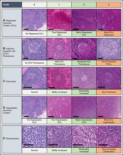 Figure 3. Grading of pathologic features seen in iMCD. The following images are examples of the respective grades for each histopathologic feature. Deidentified lymph node slides were obtained prestained with hematoxylin and eosin from Janssen Pharmaceuticals and scanned using an Aperio CS scanner (Leica Biosystems, Wetzlar, Germany) at 20×/0.75NA Plan Apochromat. Images were captured using Aperio Imagescope and enhanced to 300 dpi using Photoshop. Bars represent 500 μm (A,D), 80 μm (B), 200 μm (C), 60 μm (E). (A) Regressed/atrophic germinal centers. (B) Follicular dendritic cell prominence. (C) Vascularity. (D) Hyperplastic germinal centers. (E) Plasmacytosis.