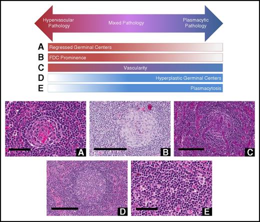 Figure 5. Histopathologic features of CD. Hypervascular subtype is characterized by the presence of regressed germinal centers and FDC prominence, whereas the plasmacytic subtype exhibits hyperplastic germinal centers and profuse plasmacytosis. Mixed subtype exhibits a combination of hypervascular and plasmacytic features. Vascularity is frequently observed in iMCD, but can be seen with either subtype. Deidentified lymph node slides were obtained prestained with hematoxylin and eosin from Janssen Pharmaceuticals and scanned using an Aperio CS scanner (Leica Biosystems, Wetzlar, Germany) at 20×/0.75NA Plan Apochromat. Images were captured using an Aperio Imagescope and enhanced to 300 dpi using Adobe Photoshop. Bars represent 60 μm (A,E), 200 μm (B-D). (A) Regressed germinal center. (B) FDC prominence in germinal center. (C) Blood vessels penetrating germinal center demonstrate prominent vascularity. (D) Hyperplastic germinal center. (E) Sheetlike plasmacytosis.