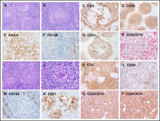 Figure 2. Representative images showing immunohistochemical expression in patients with UCD and iMCD. (A-H) UCD case with B-cell–rich germinal centers and increased CD5+/CD19+ B cells, whereas CD3+ small T cells are relatively sparse. (I-P) iMCD case with dense T cells in the interfollicular regions and decreased CD20/PAX-5 B cells and CD5+/CD19+ B cells. Few polyclonal CD138+ PCs are present around the nodules in both UCD and iMCD. Original magnification ×100 for panels A-D,I-L and ×200 for panels E-H,M-P.