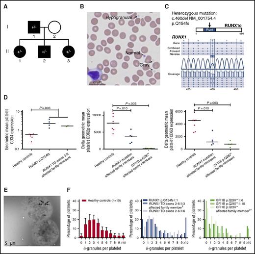 Figure 1. CD34 expression and granule contents of RUNX1- and GFI1B-mutated platelets. (A) Pedigree of the family harboring a heterozygous RUNX1 p.Q154fs mutation (indicated by ±). Thrombocytopenia is indicated with black shapes. Also the deceased mother of case I:1 had a history of thrombocytopenia (data not shown), suggesting autosomal dominant inheritance of the disease. Four family members were screened for the mutation (all ±). □: male, ○: female. Pedigrees from the RUNX1 tandem duplication exons 2-6 and GFI1B p.Q287* families were published before.1,5 (B) MGG-stained blood film of proband I:1 (RUNX1 p.Q154fs) showing normal, hypogranular, and agranular (gray) platelets (arrows). Original magnification ×40, VisionTek Sakura, VisionTek Live 2.6. (C) Sequencing of RUNX1 revealed a heterozygous mutation (c.460del NM_001754.4, p.Q154fs) in all tested affected family members. Results from the proband I:1 are shown. (D) Geometric MFI of CD34 expression on CD41-positive platelets measured by flow cytometry showing that thrombocytopenic individuals from RUNX1-mutated families (p.Q154fs cases I:1, II:1-II:3, and tandem duplication exons 2-6 cases II:3 and II:6) have higher platelet CD34 expression than healthy controls. The line indicates the median (left). Geometric MFI of CD62p on CD42a-positive (middle) and CD63 on CD42b-positive (right) platelets (thrombin-stimulated minus unstimulated). On average, individuals from RUNX1-mutated families (p.Q154fs cases I:1, II:2, II:3, and tandem duplication exons 2-6 cases II:3 and II:6) and the GFI1B p.Q287*-mutated family (cases II:6, II:10, and the last case from Table 1, plus cases II:3 and II:8 from Monteferrario et al1) had decreased CD62p and CD63 expression compared with healthy controls. (E) Whole mount EM on platelets from proband I:1. All δ-granules are indicated with arrows. The lower of the two platelets is devoid of δ-granules. Original magnification ×1200, Jeol JEM 1400, Gatan digital micrograph software. (F) Quantification of δ-granules using whole mount EM. The number of δ-granules was determined for 40 or 50 platelets (counters were blinded to diagnosis). As reference, the left panel shows the percentage of platelets harboring 0 to 9 or ≥10 δ-granules for healthy controls (n = 10, each bar with whisker shows mean + 99.55% CI). The middle and right panels show that 2 of 3 thrombocytopenic individuals from RUNX1-mutated families and 3 of 3 from GFI1B p.Q287*-mutated families had an increased percentage of platelets harboring no δ-granules (affected: 12% to 40%; healthy controls: 0% to 4.4% with a 99.55% CI). The median number of δ-granules per platelet was significantly decreased for GFI1B p.Q287* cases compared with controls (P = .013). Because results from the 3 individuals from RUNX1-mutated families were not consistent, the median number of δ-granules per platelet was not significantly decreased for these cases compared with controls (P = .08). One of 3 and 2 of 3 individuals from RUNX1- and GFI1B-mutated families, respectively, had increased percentages of platelets containing ≥10 δ-granules (affected: 10% to 22%; healthy controls: 0% to 5.2% with a 99.55% CI). ‡These individuals were thrombocytopenic, but not tested for the indicated mutation. †This case is a son of case II:10 and nephew of II:6, but was not included in the previous publication.1 All P values were obtained using the 2-sided Mann-Whitney U test. CI, confidence interval; MFI, mean fluorescence intensity; TD, tandem duplication.