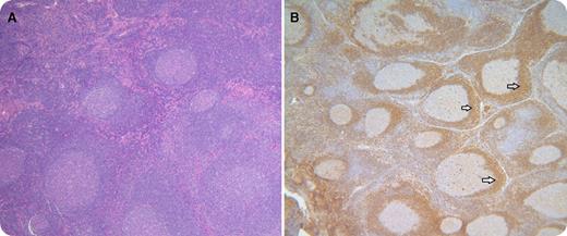 A 13-year-old girl was referred for adenopathy. At 6 years of age, she developed recurrent otitis media; at 11 years of age, she developed cervical adenopathy. Computed tomography imaging documented splenic hilar adenopathy and splenomegaly (15.7 cm). Immunoglobulins were normal. Antibody responses to pneumococcal vaccination were <0.3 mg/dL. T-cell responses to Candida albicans were absent. Increased CD19+ B cells (44%; normal, 17%-24%) and naive (CD19+CD27−) B cells (90%; normal, 61%-83%) as well as diminished memory (CD19+CD27+) B cells (10%; normal, 17%-39%) were noted. Family history disclosed a maternal history of recurrent adenopathy and lymphoma in the maternal grandfather. A lymph node biopsy demonstrated follicular hyperplasia (panel A; original magnification ×4, hematoxylin and eosin stain) and expanded mantle zones with immunoglobulin D+ B cells (panel B; original magnification ×4, immunohistochemical stain for immunoglobulin D) as depicted. A heterozygous missense mutation (c.146G>A) in exon 3 of the CARD11 gene was documented. / B-cell expansion with NF-κB and T-cell anergy (BENTA) is a congenital lymphoproliferative disorder linked to germ line–encoded, gain-of-function mutations in CARD11, encoding the CARD-containing MAGUK protein 1 (Carma 1). Carma 1 is required for antigen receptor–induced NF-κB activation in lymphocytes. Splenomegaly, polyclonal B-cell lymphocytosis, otitis media, poor antibody responses to polysaccharides, and mild T-cell immunodeficiency were suggestive of BENTA.