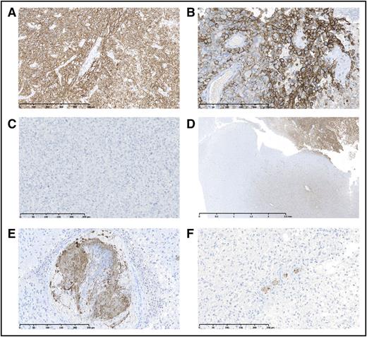 Figure 1. Representative samples showing podoplanin expression and intravascular platelet clusters (antiplatelet surface protein CD61) in brain tumor specimens. (A-B) Representative examples of high podoplanin (+++)-expressing tumors. (C) Representative example of a podoplanin-negative (–) tumor. (D) The invasion zone of a podoplanin-expressing tumor is depicted. (E) A very large CD61+ intravascular thrombosis (+++) is shown. (F) Tumor sample with multiple CD61+ thrombotic vessels (++). NDP Viewing Software (NDP.view2; Hamamatsu Photonics, Japan) was used for microscopy photographs. Full scale bars represent 500 μm (A), 250 μm (B-C,E-F), and 2.5 μm (D).